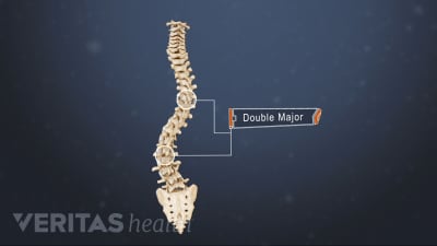 Scoliosis