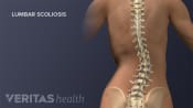 Posterior view of the adult spine showing lumbar scoliosis.