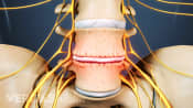 Anterior view of the lumbar spine with degenerative dis disease.