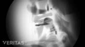 X-ray of an artificial disc in the cervical spine
