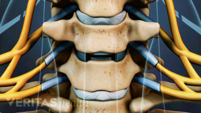 Disc Replacement Back Surgery
