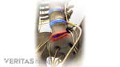Anterior view of degenerative disc disease in the lumbar spine.