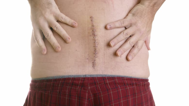 A 4-6 inch suture on a person&#039;s lower back.