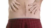 Posterior view of the lower back showing a scar in the lumbar spine.