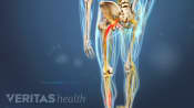 Herniated Disc