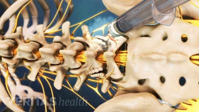 Medial Branch Block