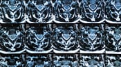 MRI Scan of the cervical spine