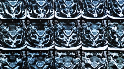 MRI Spine