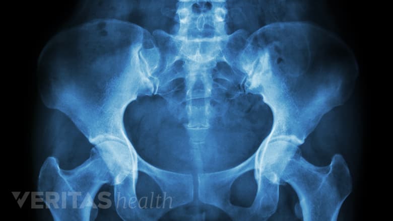 An image of an pelvis xray.