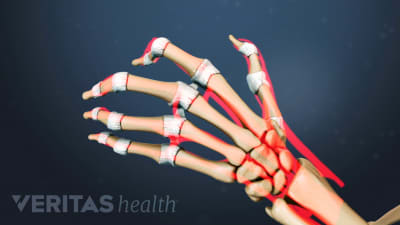 Arthritis