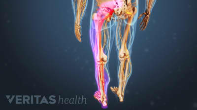 Posterior view of pain radiating down the left leg.