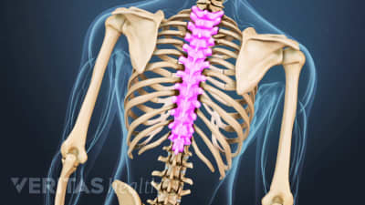 Spinal Tumor