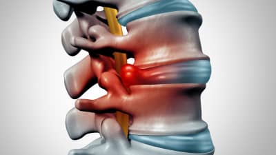 Herniated disc in the lumbar spine radiating pain