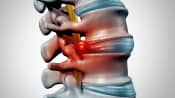Herniated disc in the lumbar spine radiating pain