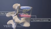 Vertebrogenic Low Back Pain and Pain Signals