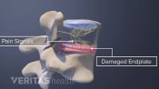 Vertebrogenic Low Back Pain and Pain Signals