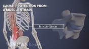 Muscle strain in the lower back