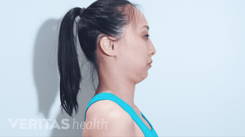 A therapist performing chin tuck exercise.