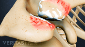 Bone spurs on facet joints.