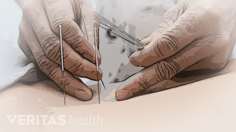 An illustration showing acupuncture therapy performed.