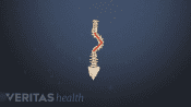 Medical illustration of a severe adolescent idiopathic scoliosis curve