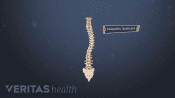 Posterior view of idopathic scoliosis