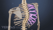 Illustration of spine with idiopathic scoliosis curve