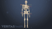 Medical illustration of a skeleton showing signs of scoliosis