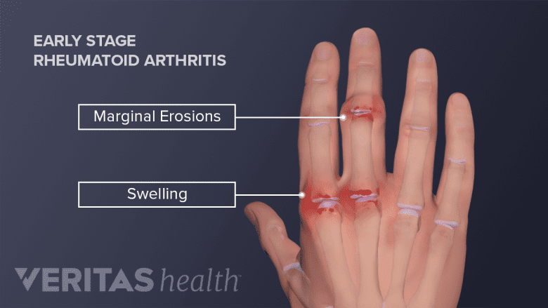 Illustration showing a hand showing marginal erosions in the fingers.