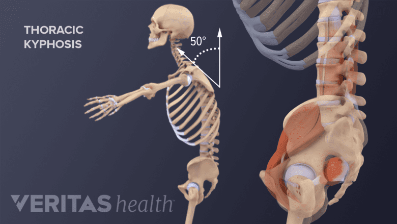 Profile vide of pelvis and whole body showing thoracic kyphosis.