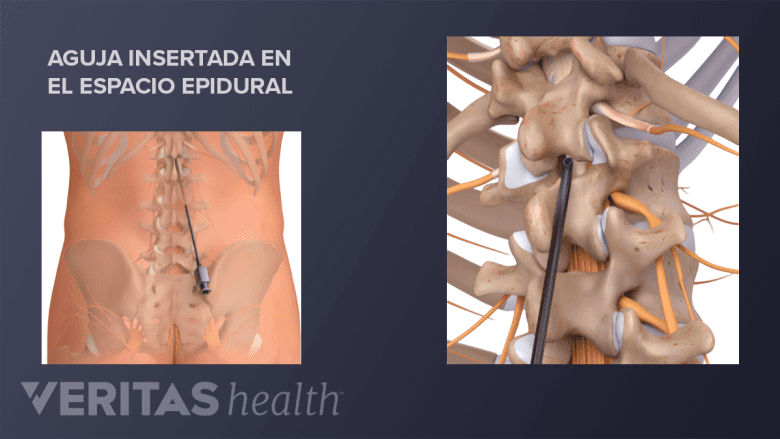Una aguja insertada en el espacio epidural.