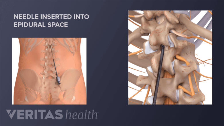 A needle is inserted into the epidural space of the lumbar spine.