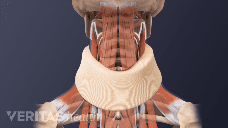 Illustration showing  muscles in the neck  with a collar brace.
