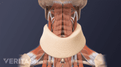 Illustration showing neck with neck brace.