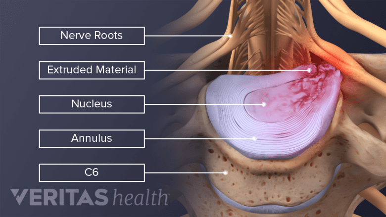 Illustration showing herniated cervical vertebra.