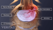 Illustration of C6-C7 herniation and nerve impingement. Nerve roots, nucleus, annulus, material impinges onthe nerve and the 7th cervical vertebra are labeled.