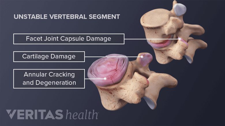 Labeled diagram showing an unstable vertebrae.