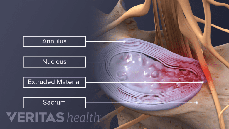 Top down labeled view of a herniated L5-S1 disc.