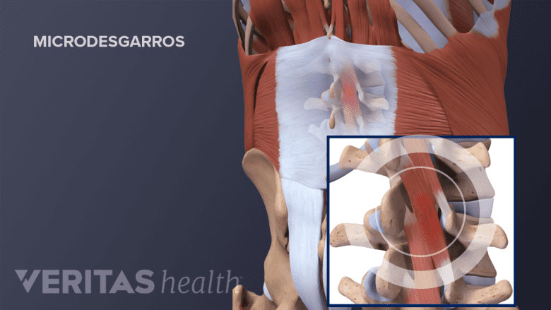 Microdesgarros en los músculos de la espalda inferior.
