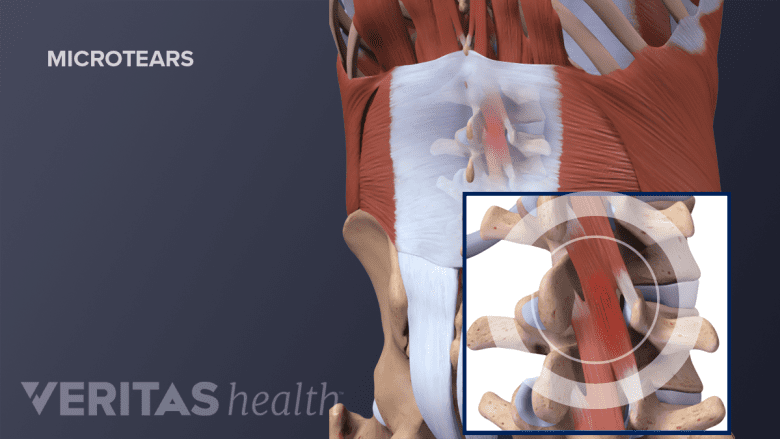 An illustration showing adult low back muscle tear.