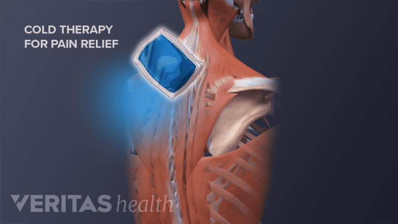 Illustration showing cold therapy effect on the neck.
