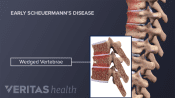 Profile view of wedged vertebrae in Early Scheuermann&#039;s Disease