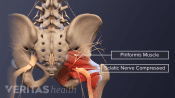 Illustration of the lower spine and pelvis highlighting the piriformis muscle and a compressed sciaitc nerve.