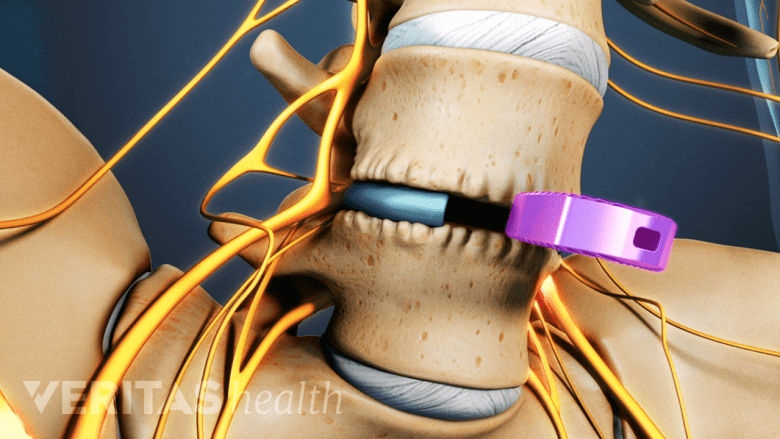 Medical illustration showing an ALIF cage implant.