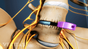 Medical illustration showing an ALIF cage implant