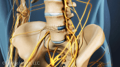 Anterior view of fused lumbar spine.