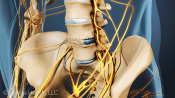 Anterior view of fused lumbar spine.