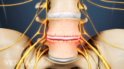 Anterior view of bone spurs in the lumbar spine.