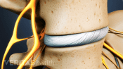 Focused on the disc between two lumbar vertebrae.
