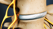 Focused on the disc between two lumbar vertebrae.